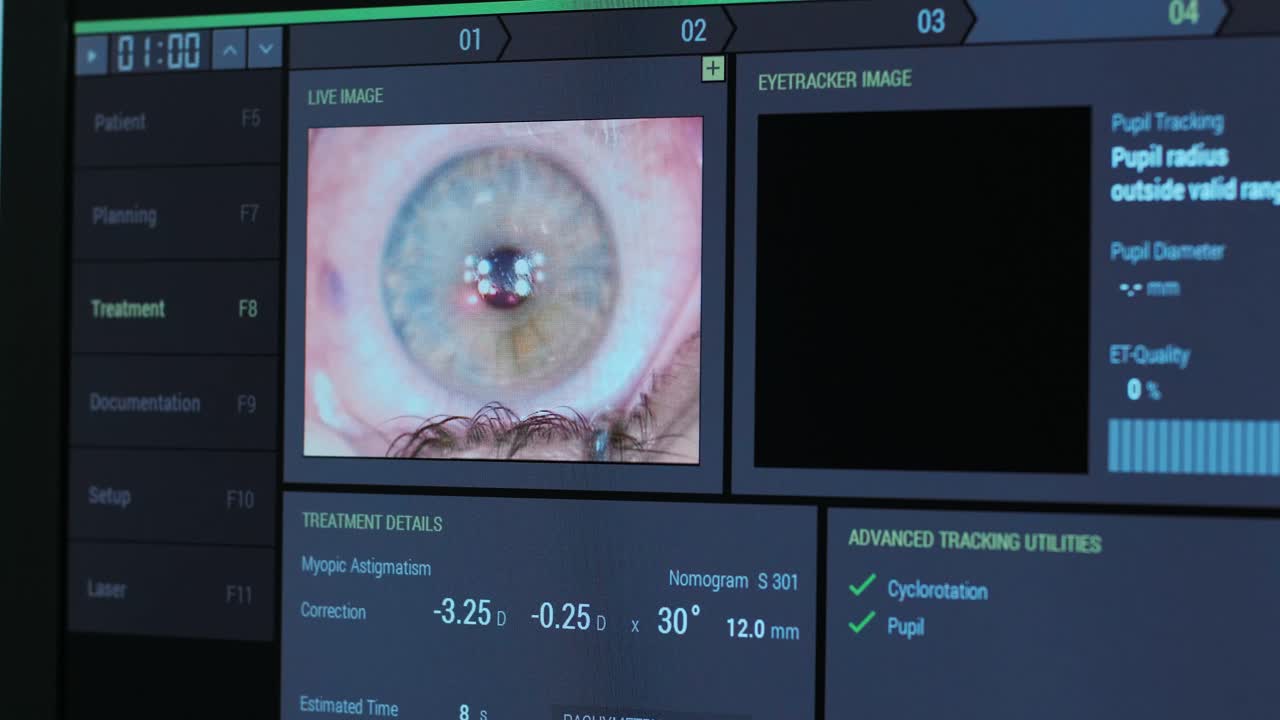 Ophthalmic surgery. View on the screen of medical monitor in operating room. Lasik