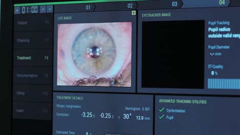 ophthalmic surgery. view on the screen of medical monitor in operating room. lasik