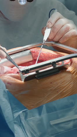 el cirujano realiza una cirugía cardíaca con láser de cerca. el médico utiliza pinzas y bisturí caliente para una complicada cirugía de derivación de la arteria coronaria en el hospital