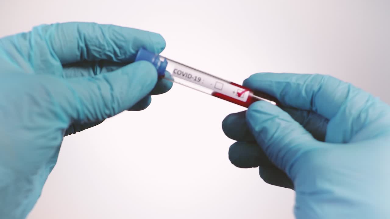 Close-up of blood sample in test tube with positive test result at Coronavirus