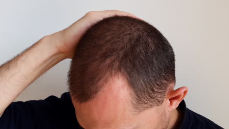 young man starts balding