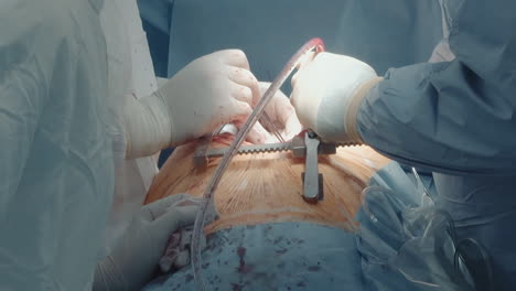 surgeon uses chest tubes operating. surgical team prepares for closing incision using tool to drain fluid and air from chest cavity in operating room