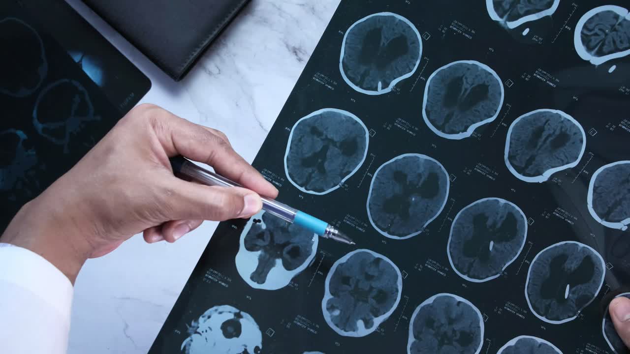 врач рассматривает снимки компьютерной томографии мозга.