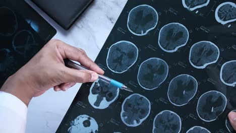 médico revisando las imágenes de la tomografía computarizada cerebral