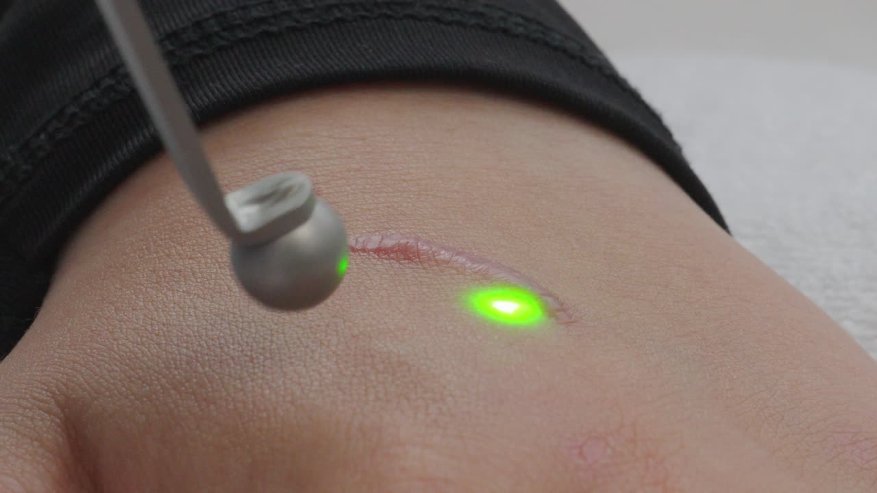 Skin scar laser treatment on hand. Medical laser macro close up.