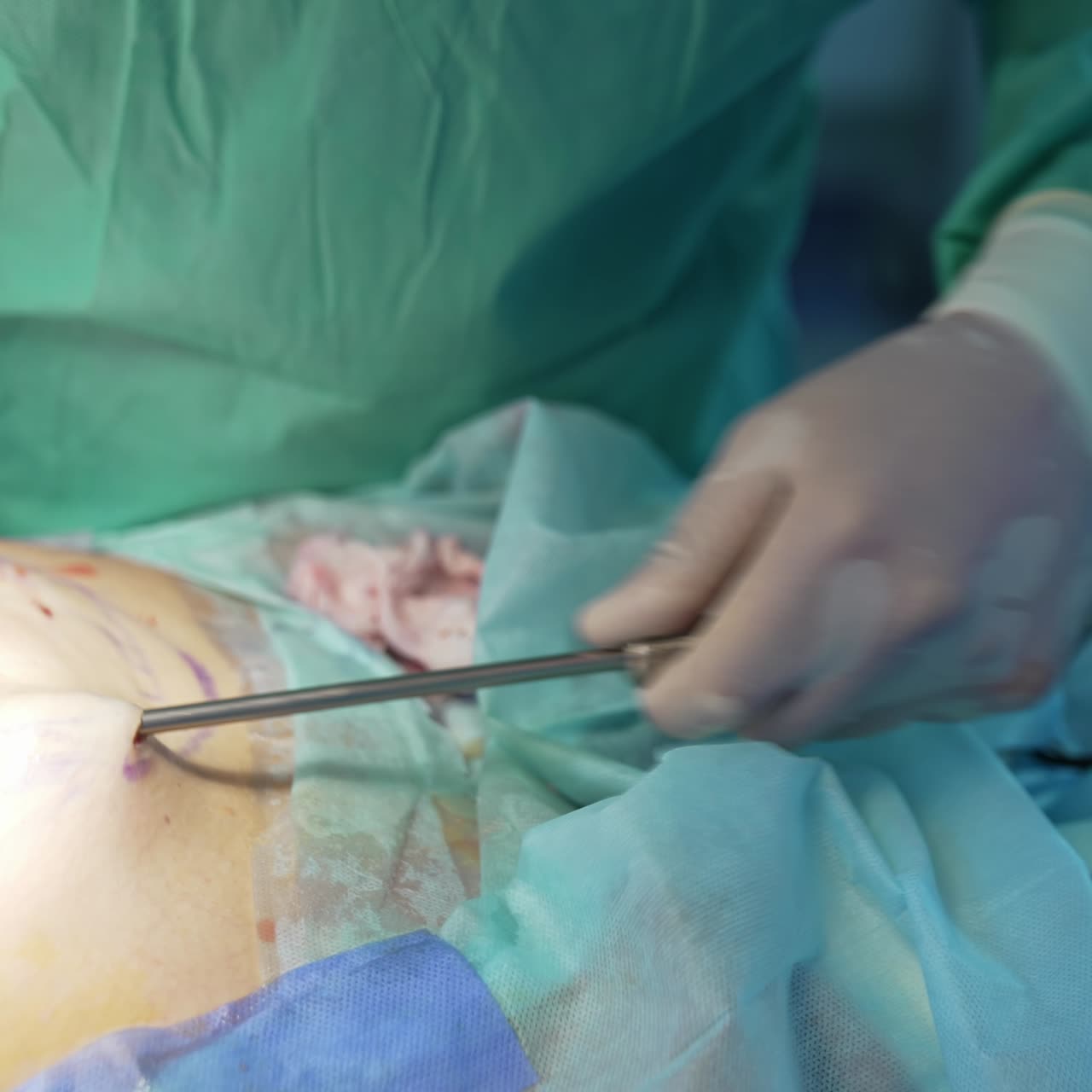 Pumping fat during liposuction. Doctor's hands in sterile gloves performing operation to a patient's belly with medical instrument. Close-up