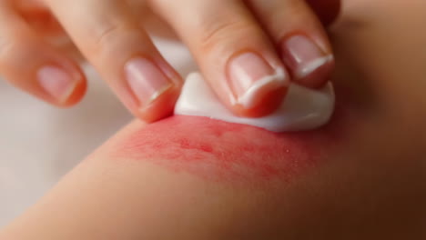 applying cream to a burn