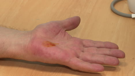 burn on hand