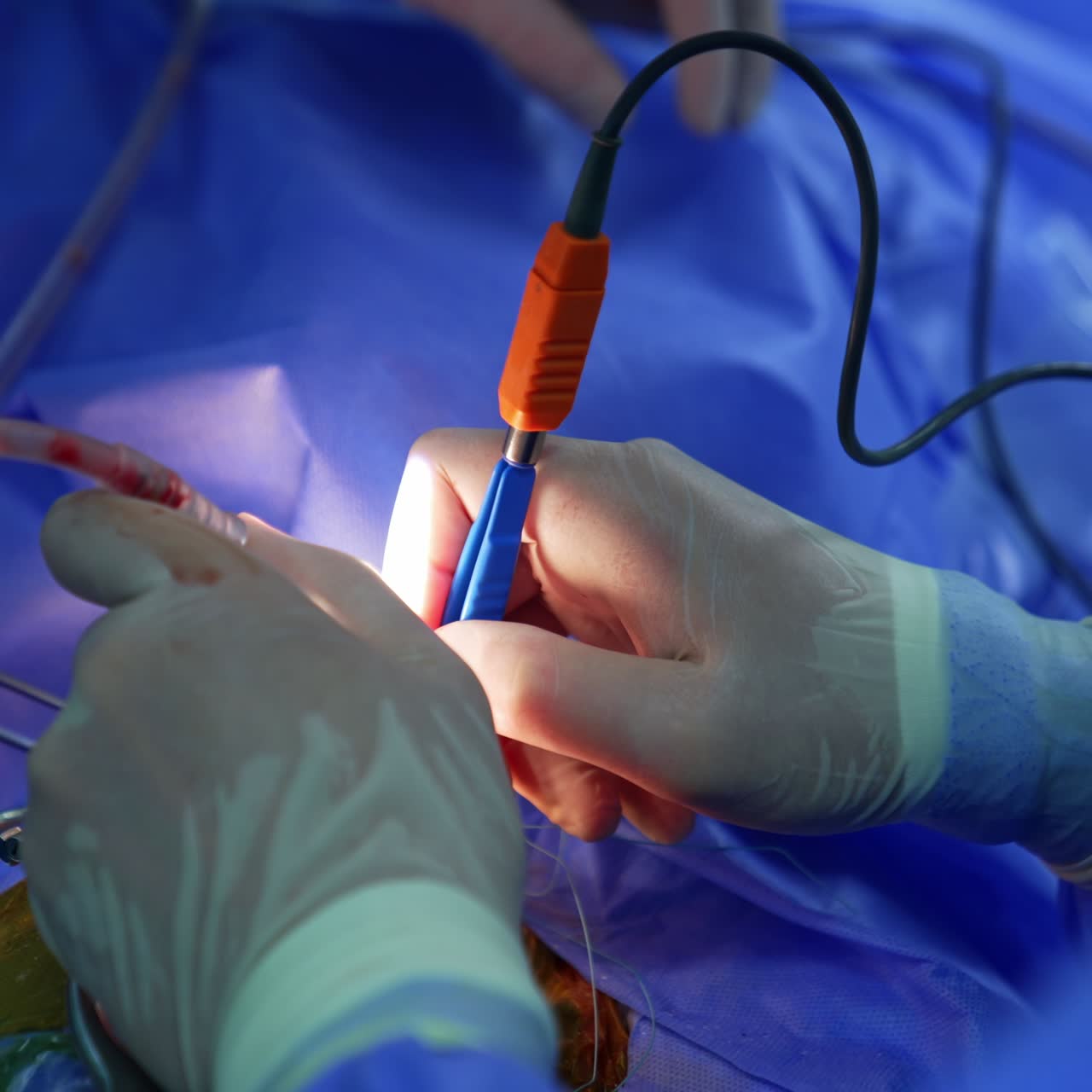 Gloved hands of a doctor holding the electric tools. Another pair of hands applying metal forceps. Close up