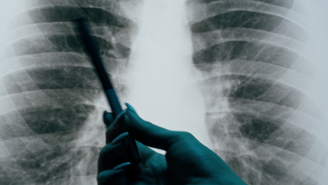 Doctor's Hand Pointing to Lungs on a Chest X-Ray
