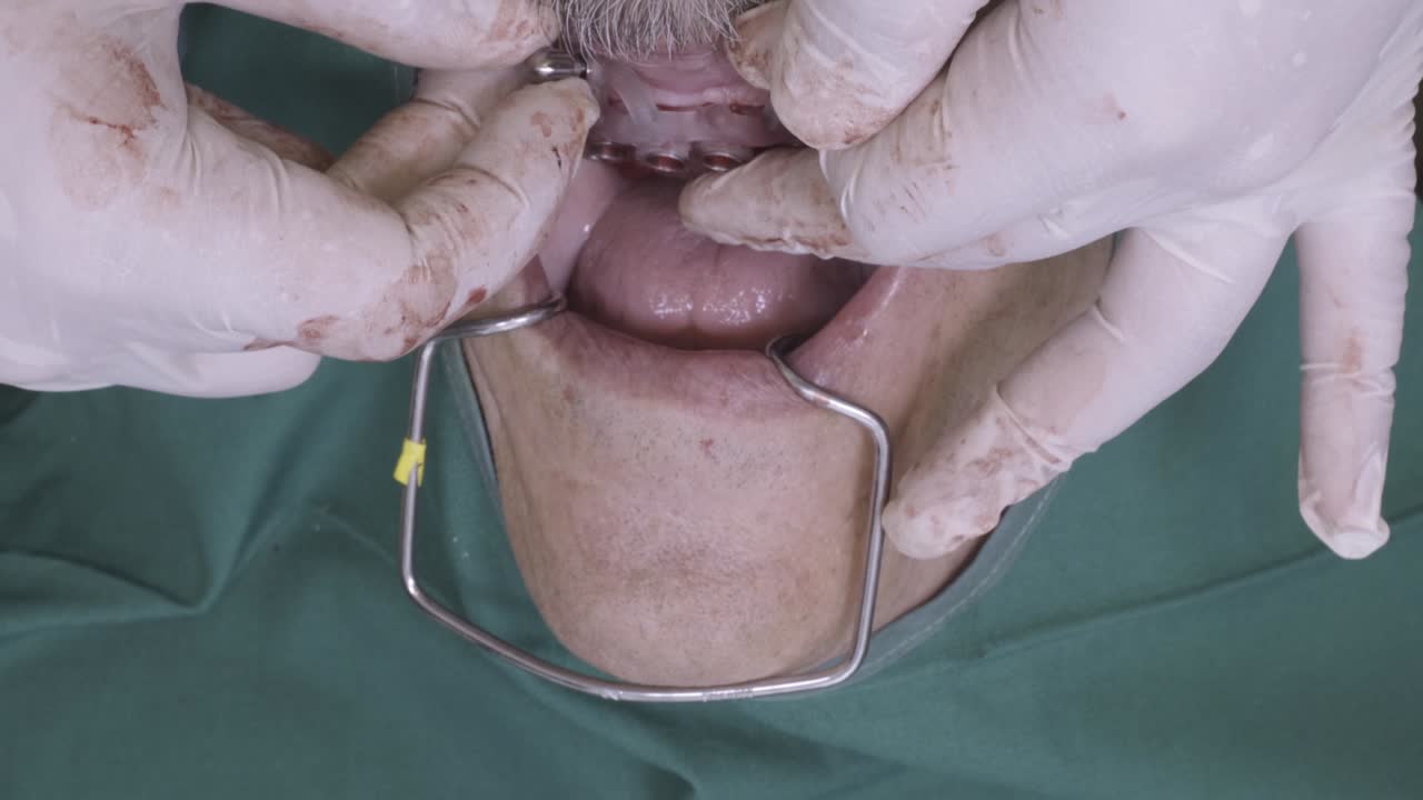 Dentist adjusting a dental implant structure during an oral surgical procedure