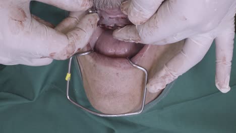 dentist adjusting a dental implant structure during an oral surgical procedure