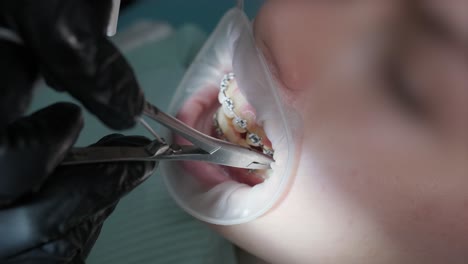 close up of dentist hand using dental forceps while putting orthodontic braces on female patient teeth. woman having dental procedure in clinic. concept of dentistry and orthodontic treatment.