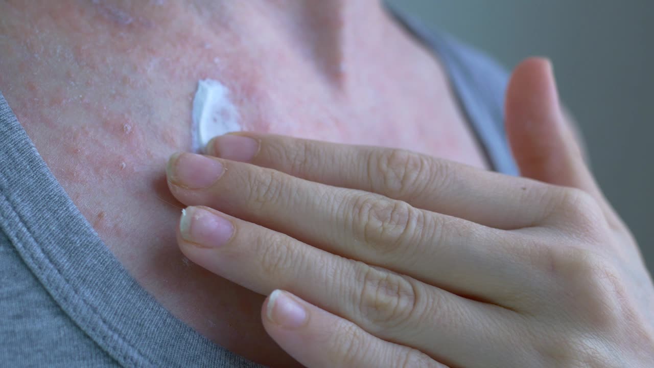 약간의 기름은 기름의 튜브에서 가져와 피부에 적용됩니다, 작은 은색 여드름과 함께 염증. 바이러스 질병. 근접