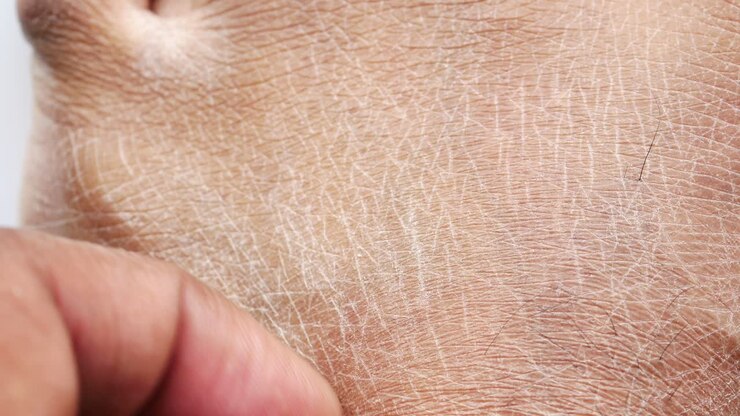 Close Up Of Dry Skin On A Person's Hand