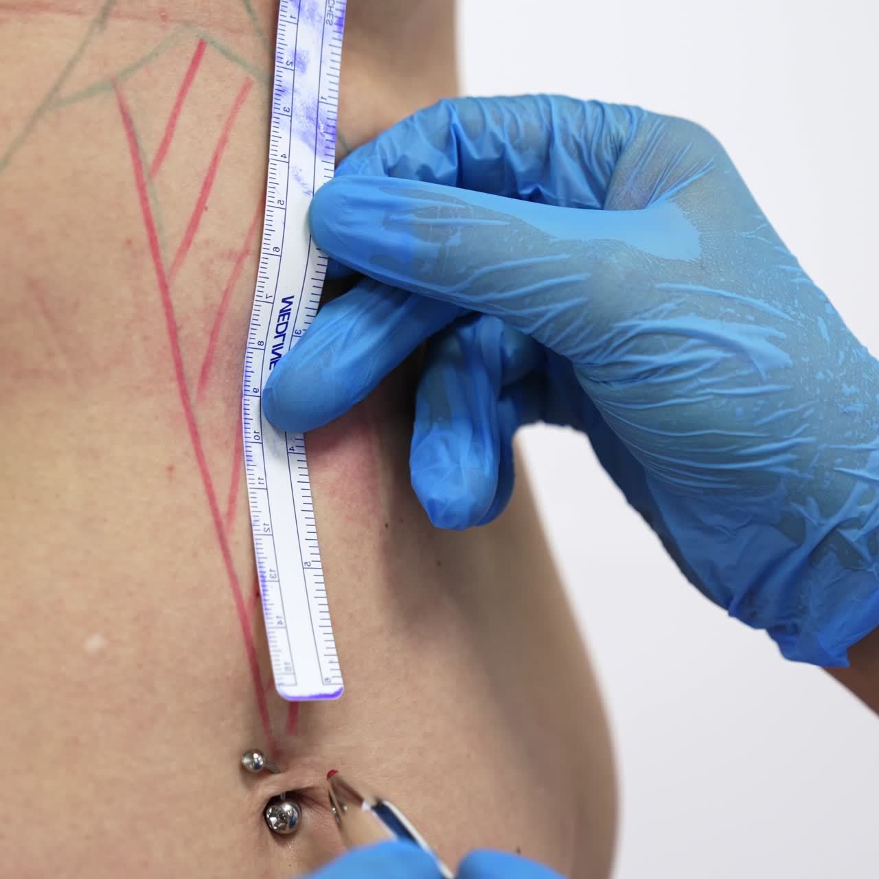 Doctor's hands in latex glove draw lines of different colors on patient's abdomen. Doctor attaches ruler to woman's belly