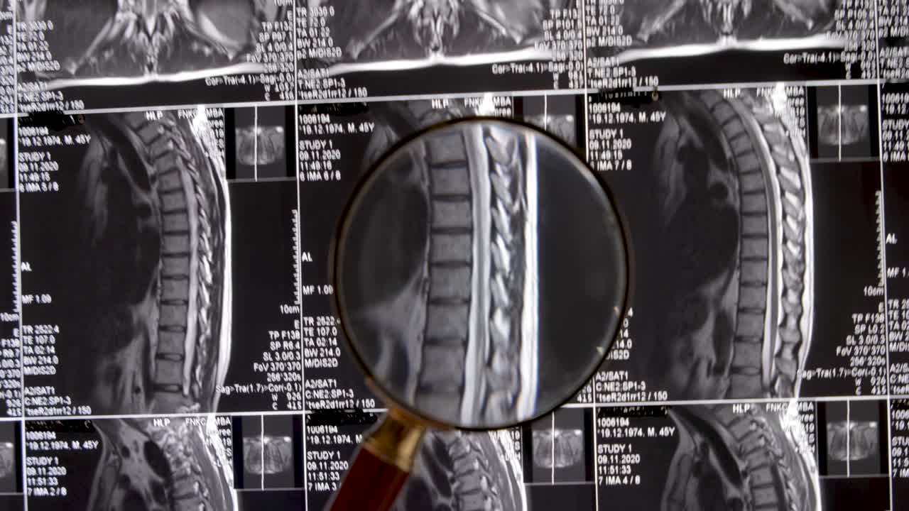 림버 척추 배경 mri, 자기 공명 검사. 의사는 림버 척추의 mri를 검사하여 척추와 신경의  ⁇ 힌 디스크를 검사합니다.
