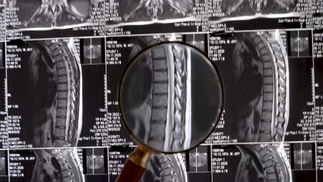 mri lumbar spine background, magnetic resonance tomography. doctor examines mri of lumbar spine with pinched discs of spine and nerves.