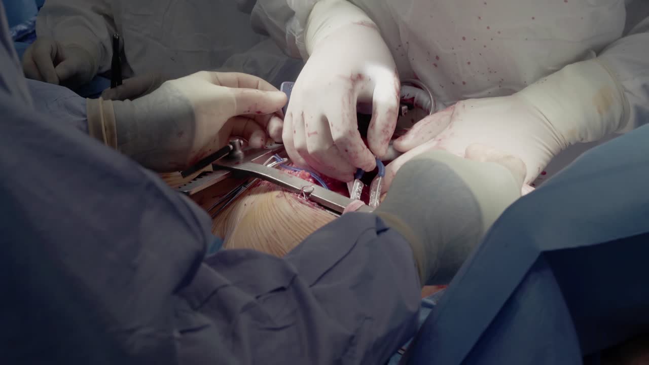 los cirujanos cardíacos realizan cirugías cardíacas