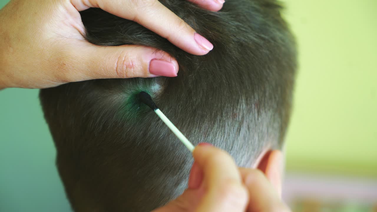 Little boy with chickenpox. Mother applying antiseptic solution to rash. Home treatment.