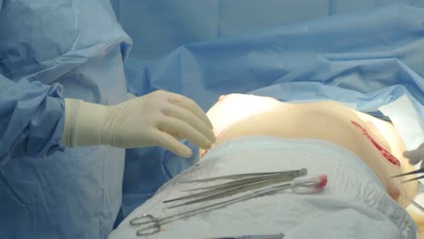 breast augmentation under the guidance surgeons team in surgical operating room