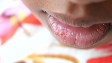 mouth sores on child