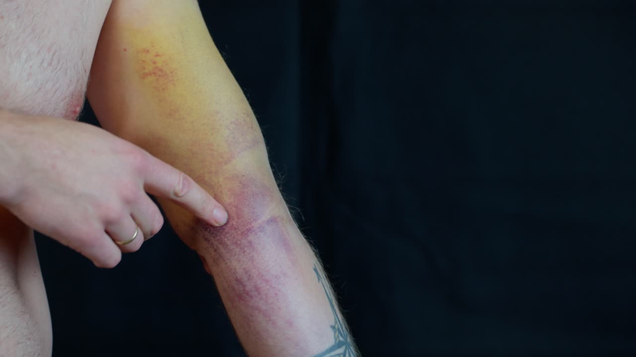 Ruptured biceps and Pectoralis Major on adult male a day after being injured, bruising changing colors, expanding to elbow, forearm