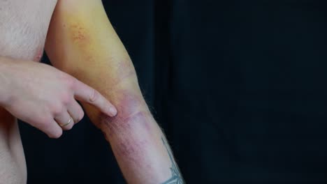 ruptured biceps and pectoralis major on adult male a day after being injured, bruising changing colors, expanding to elbow, forearm