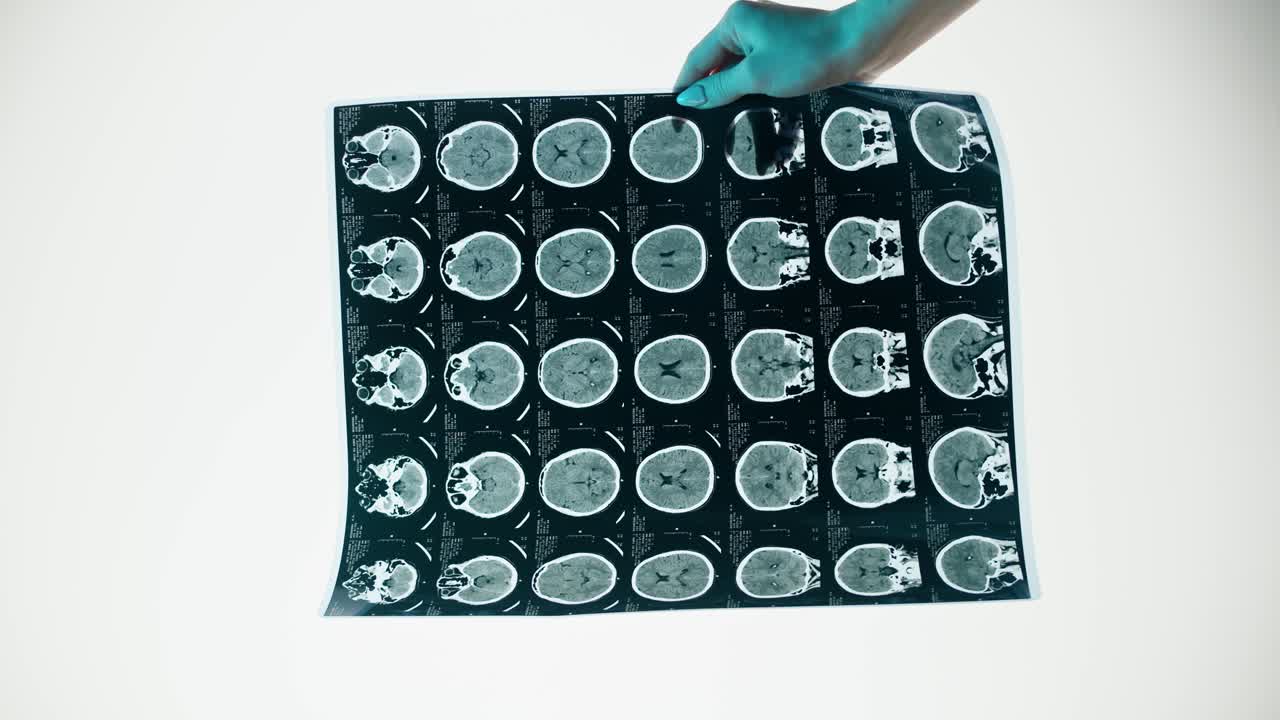 Mano che tiene ed esamina una scansione cerebrale medica
