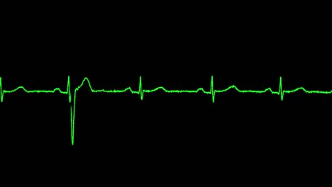 el ecg muestra una contracción ventricular prematura, arritmia.