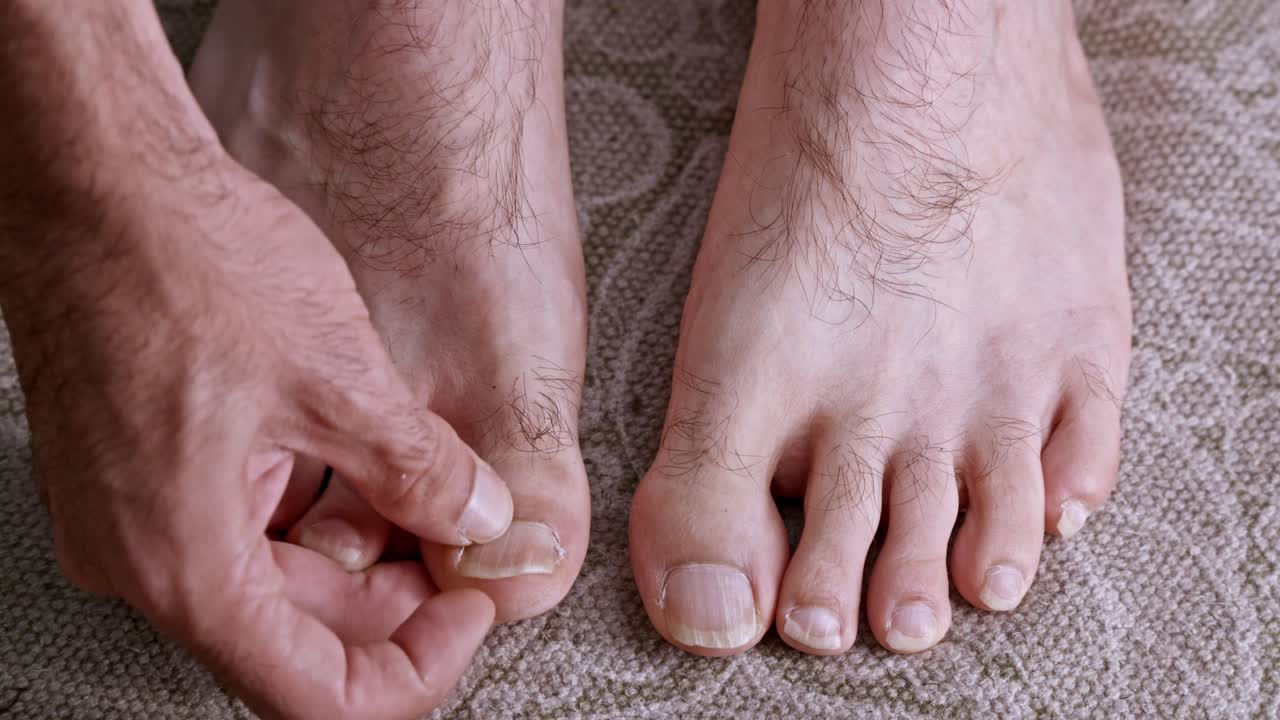 Close-up of a man's hands inspecting his hairy feet, checking his toenails for signs of fungus, onychomycosis, or other nail diseases