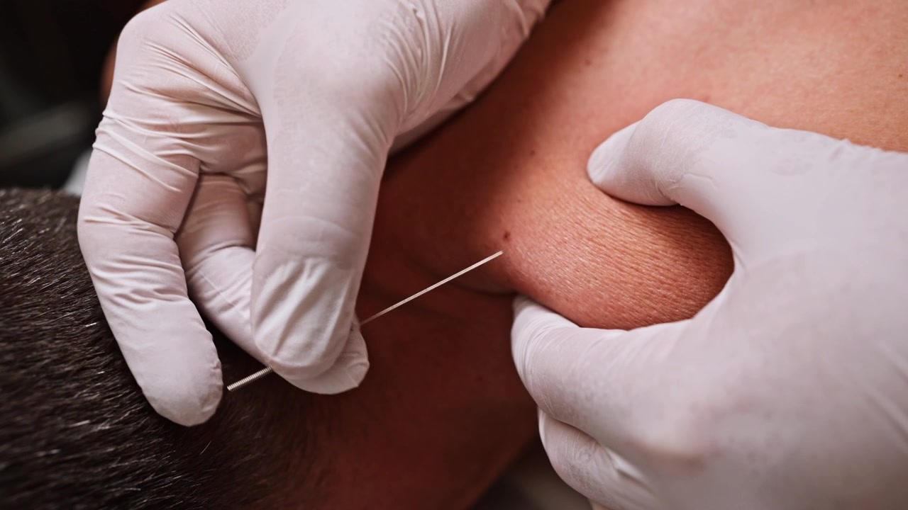 Nærbillede af Dry Needling Terapi på patientens nakke og skulder.