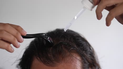 man-using-roller-hair-on-his-scalp-to-prevent-baldness,-Receding-hairline