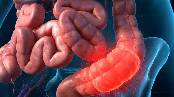 Detailed 3D render of the human intestines 3d intestines with glowing red inflamed colon section, rotating view