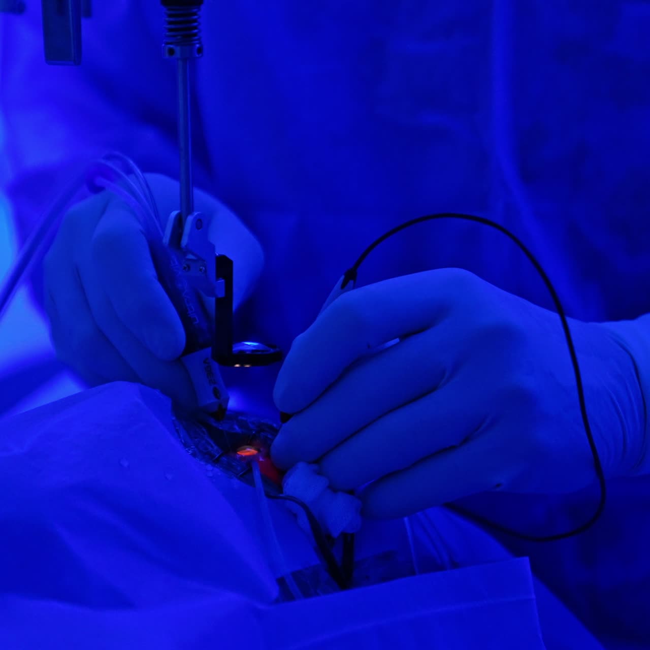 Ophthalmology procedure in the room with blue light. Gloved hands perform surgery on the eye. Close up