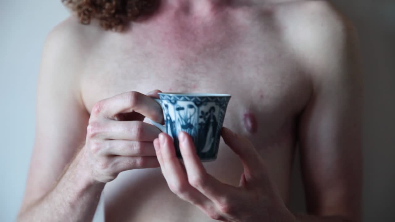 Transgender Man showing Surgery Scars on Chest