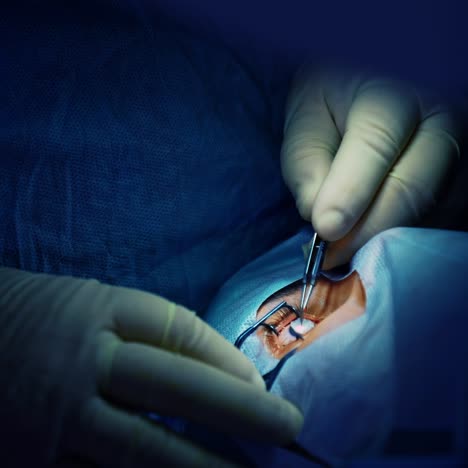 surgical procedure on opened patient's eye. professional ophthalmologist in sterile gloves operating an eye with medical tool. close-up