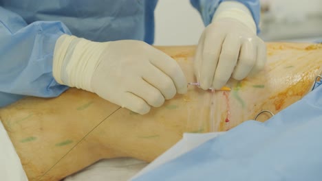 leg ulcer wound in treatment for varicose veins in phlebology procedure. bonding of veins using bioglue