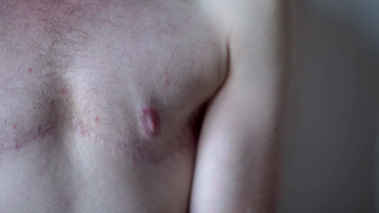 Transgender Man showing Surgery Scars on Chest