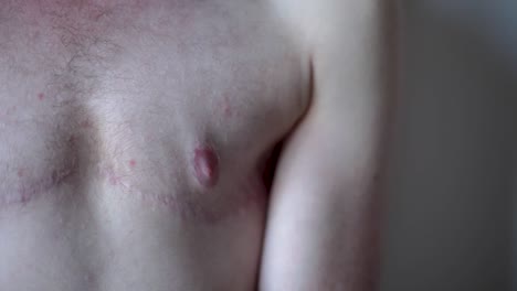 transgender man showing surgery scars on chest