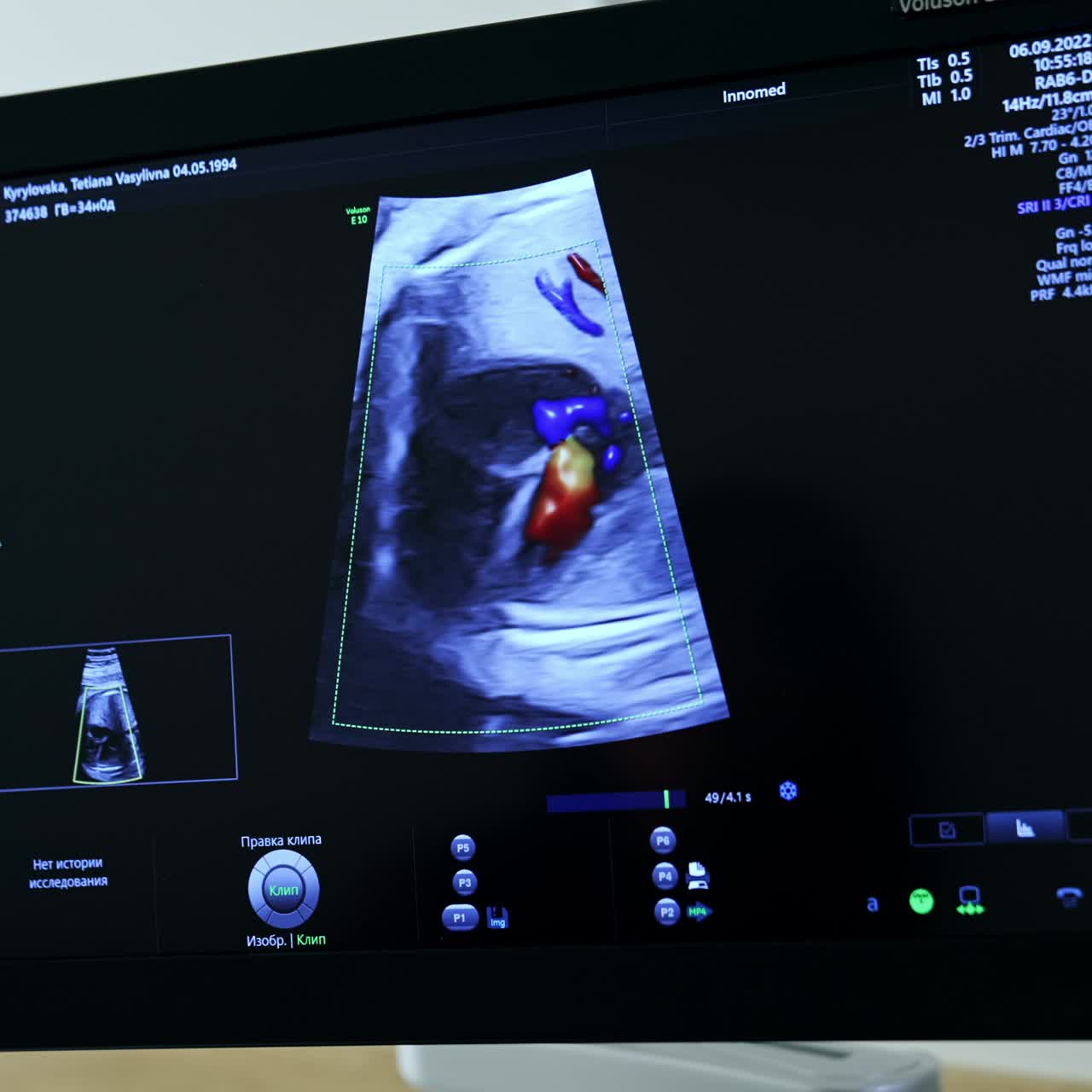 Ultrasound examination of a pregnant lady in maternity hospital. Screen on the ultrasonic machine with the image of child's organs. Close up