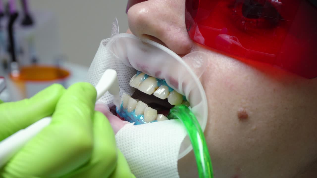 Young woman with an expander in mouth at the dental clinic. Application of protective whitening gel to the teeth. Modern dental office.