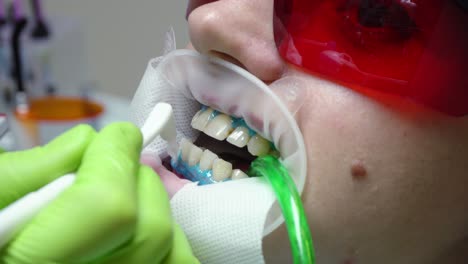 Young-woman-with-an-expander-in-mouth-at-the-dental-clinic.-Application-of-protective-whitening-gel-to-the-teeth.-Modern-dental-office.