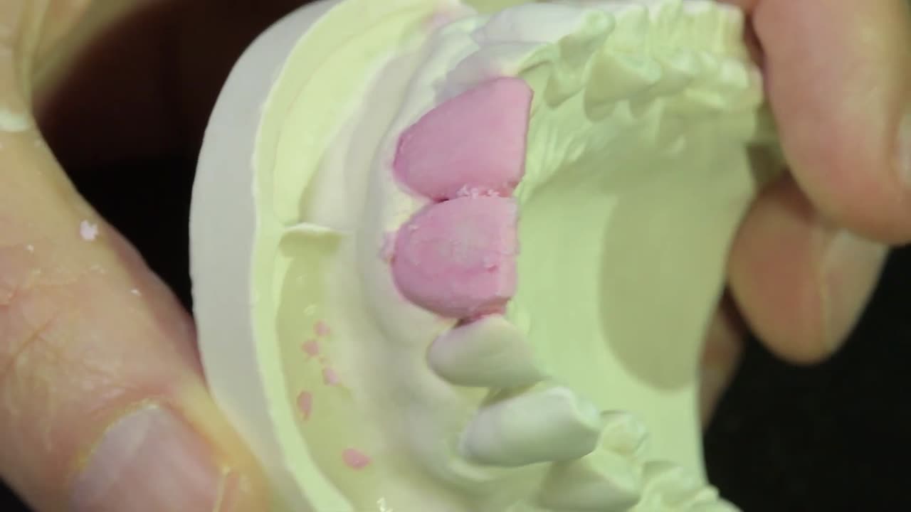 치과 세라을 쌓아 놓는 기법으로 에 층을 쌓는 기술, 근접