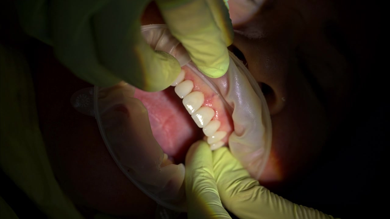 Inquadratura verticale di un dentista che indossa guanti verdi mentre posiziona l'ultima faccetta del set sul premolare. Movimento rallentato