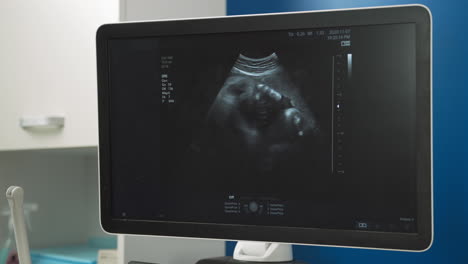 ultrasound image of a fetus
