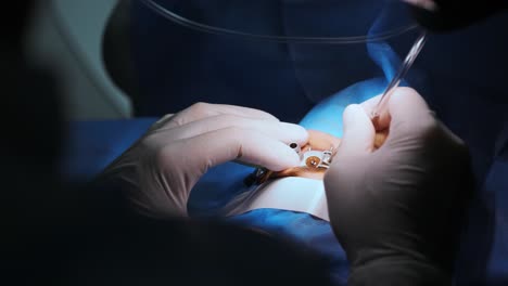 corrección de la visión con láser. un paciente y un equipo de cirujanos en la sala de operaciones durante una cirugía oftalmológica. especulo del párpado. tratamiento de lasik. paciente bajo una cubierta estéril