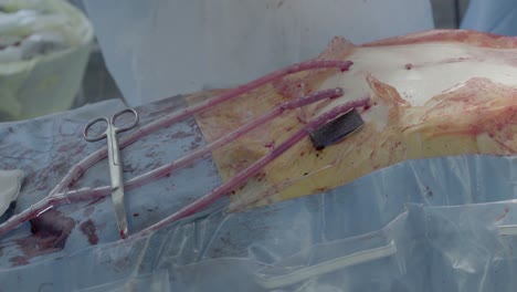 cardiosurgeons perform a cut with the help of a coagulator aorto-coronary bypass surgery is performed