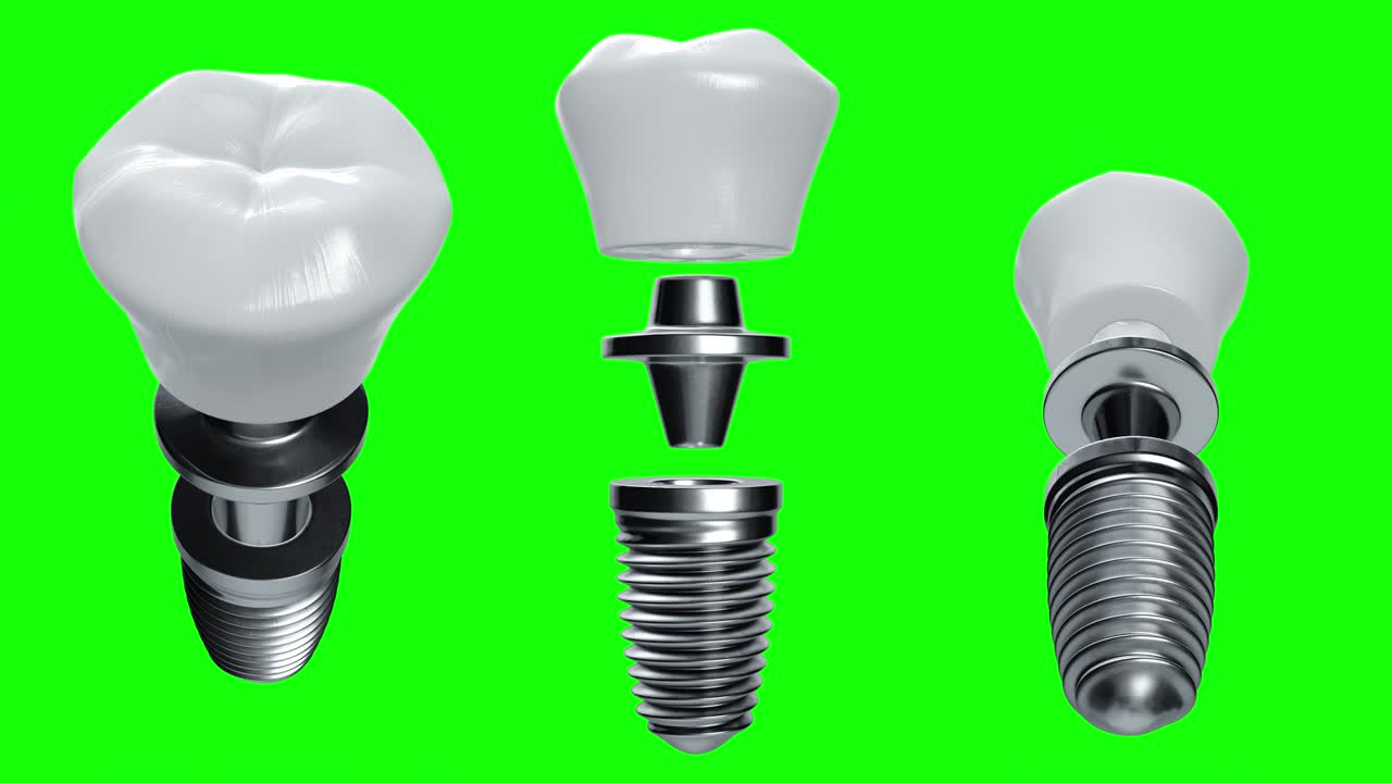 녹색 화면 배경에 티타 치과 임플란트의 3d 렌더링 모션 루핑 세트