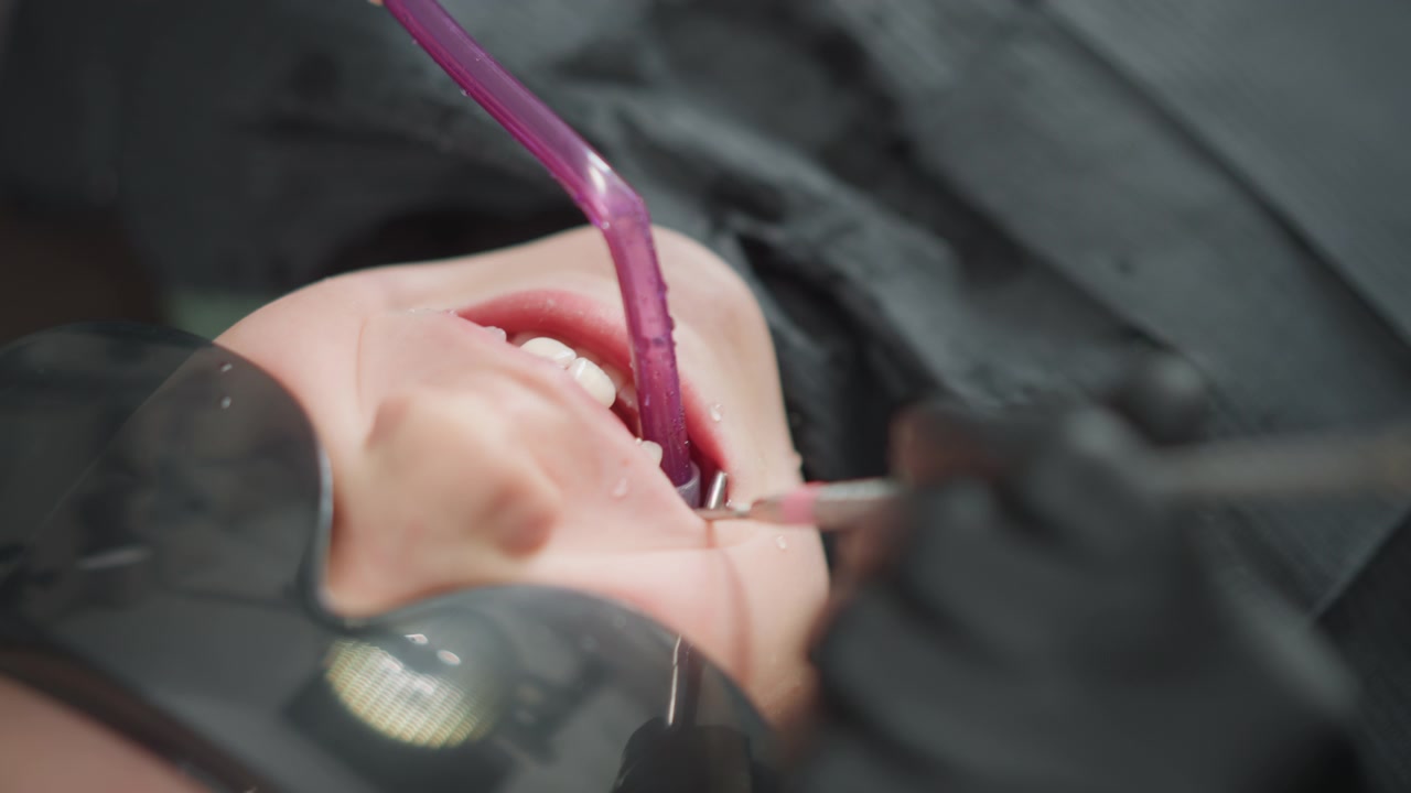 Nahaufnahme einer Person, die eine Zahnbehandlung mit Instrumenten im Mund erhält. Zahninstrumente interagieren eng, während der Eingriff fortschreitet, wobei der Fokus auf Details der Mundpflege wie Wasserspray liegt.